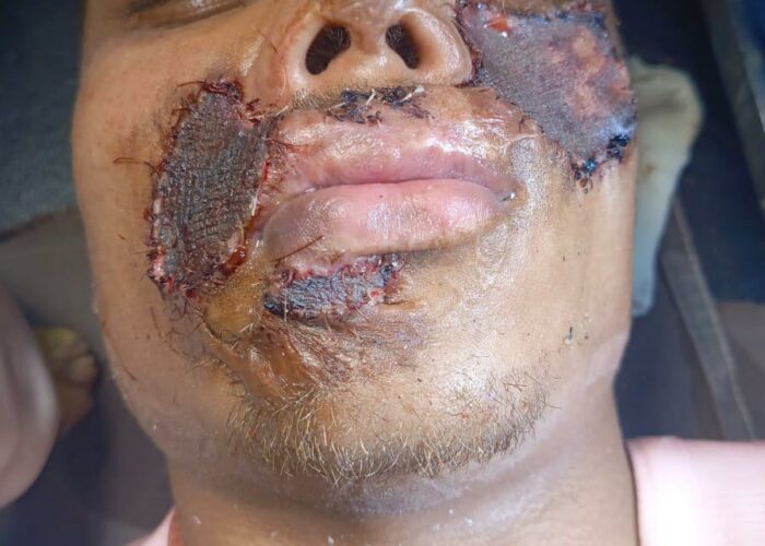 Photo 3 visage greffe